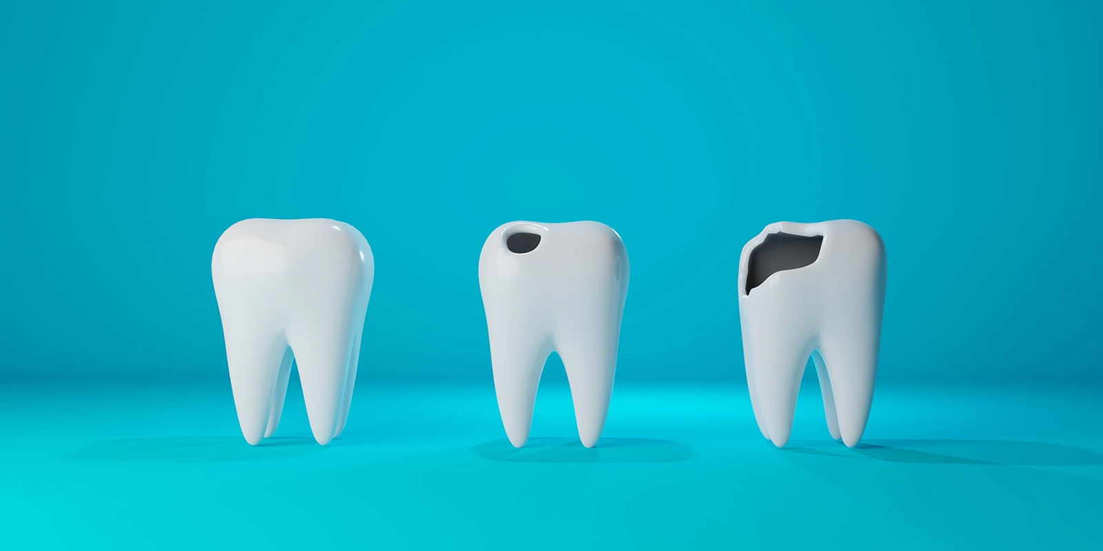 虫歯の進行度と治療について