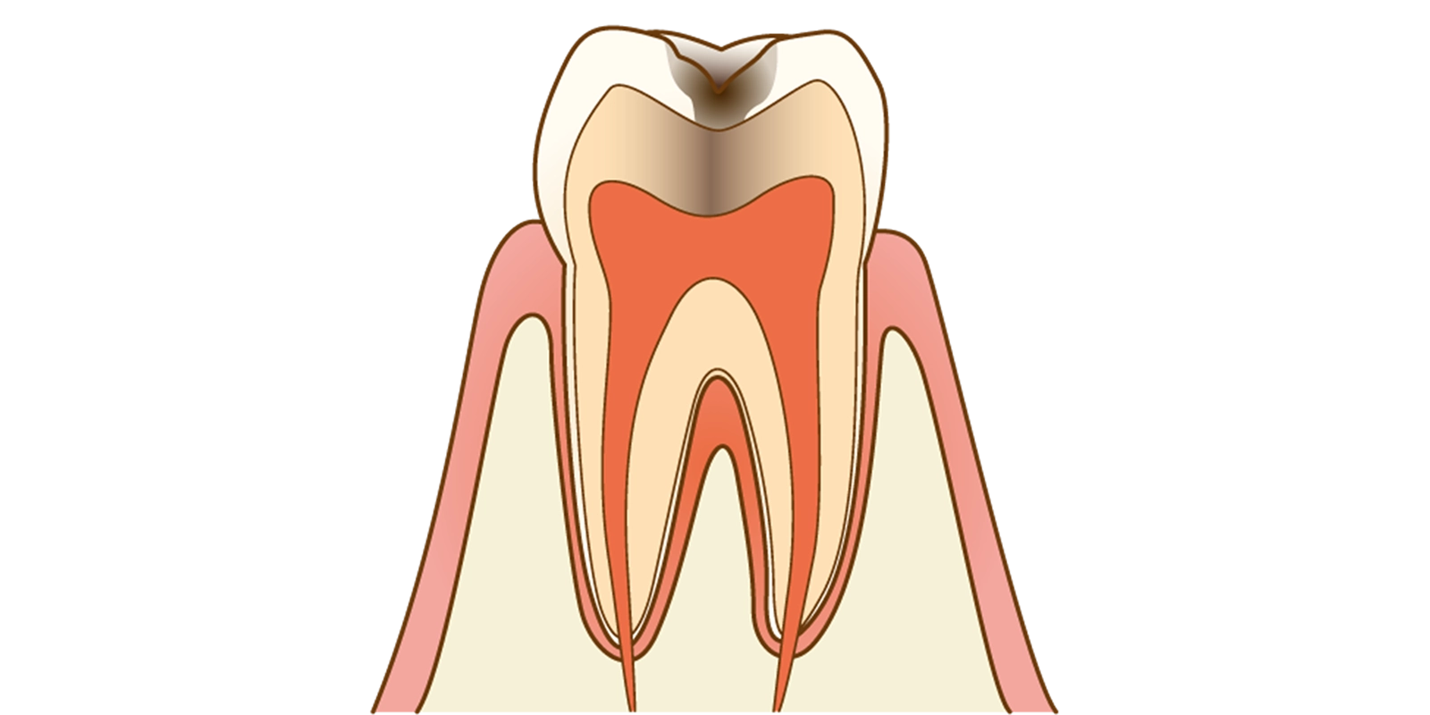 C2(象牙質まで達した虫歯)
