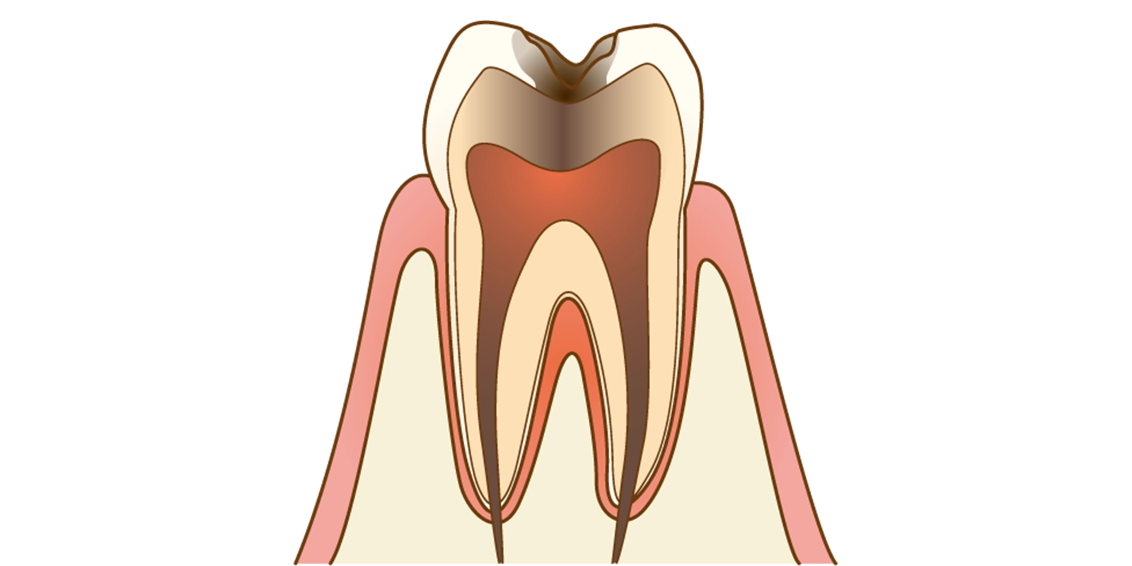C3(神経まで達した虫歯)