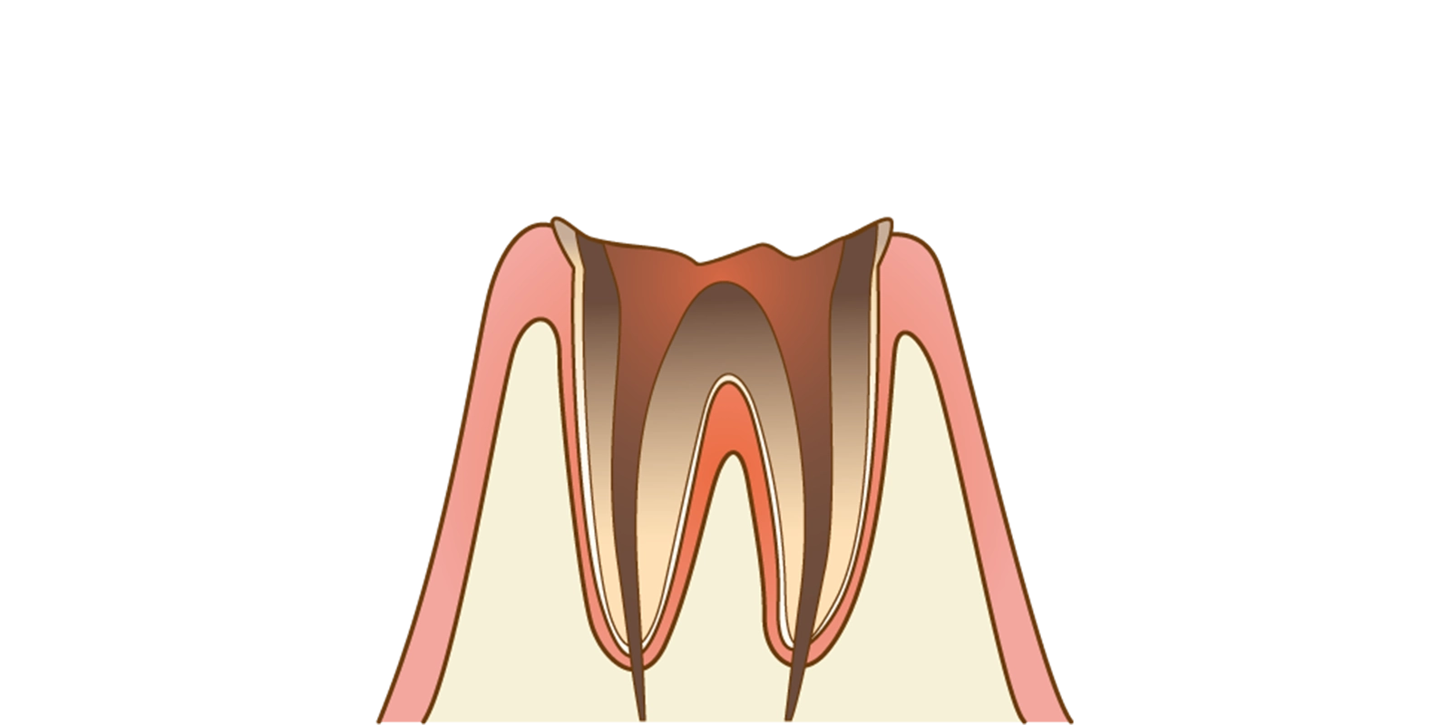C4(歯根だけが残った状態)