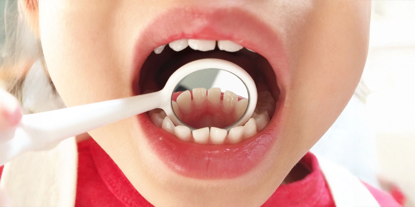 お子さまの虫歯について