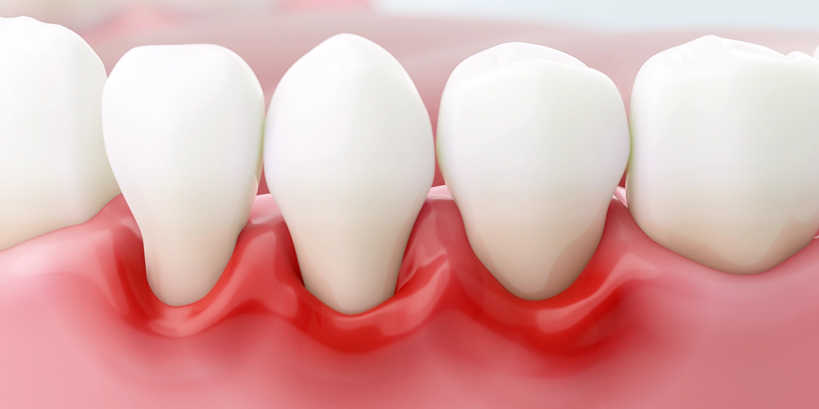 歯周病になる原因