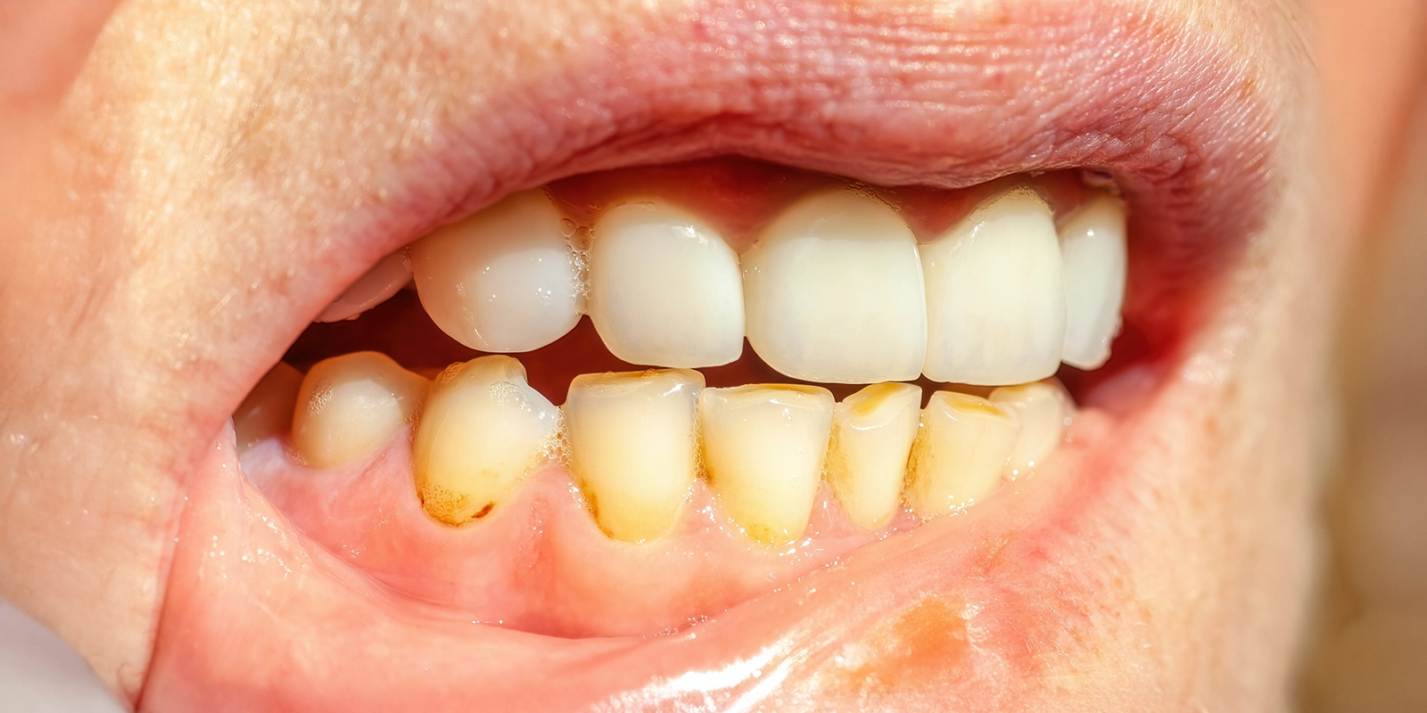 歯石やバイオフィルムについて