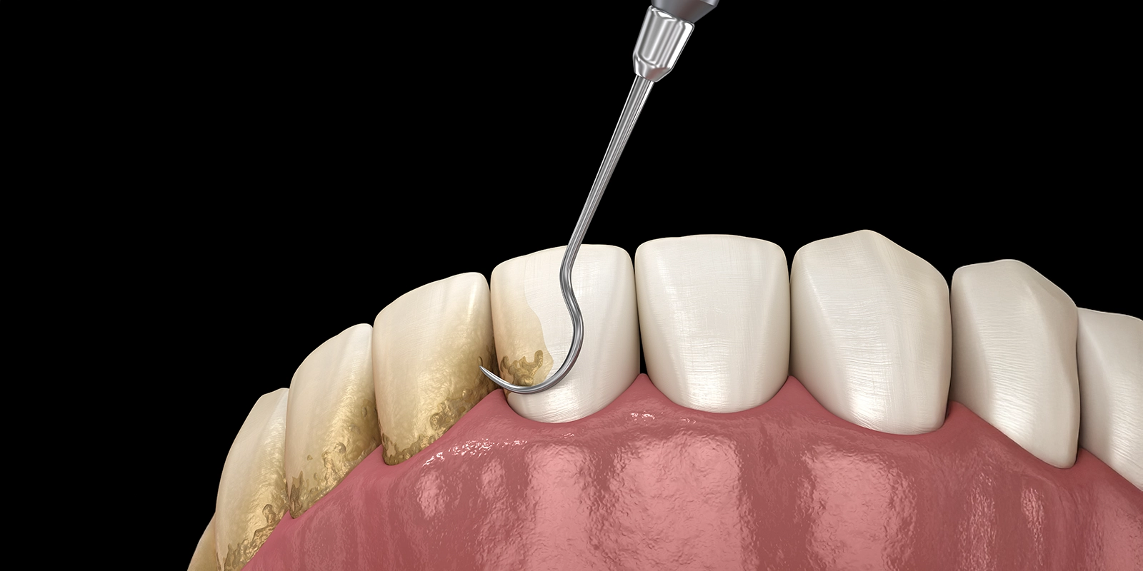クリーニング(スケーリング)について